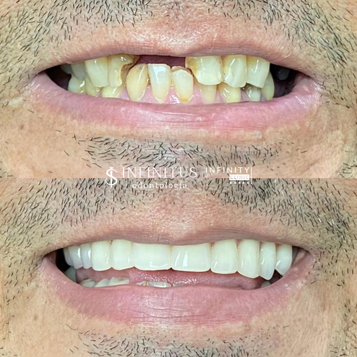 Caso real de implante — antes e depois