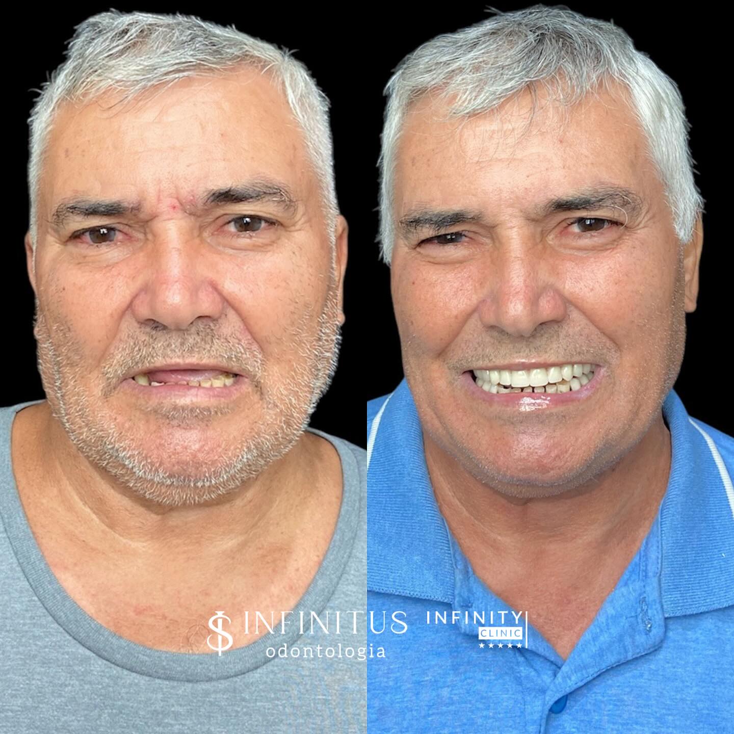 Caso real de múltiplos implantes — antes e depois